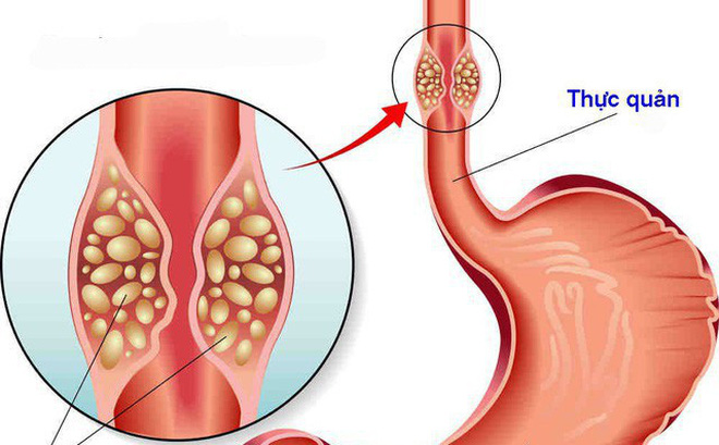 Cây xạ đen hỗ trợ điều trị ung thư thực quản Cây xạ đen hỗ trợ điều trị ung thư thực quản