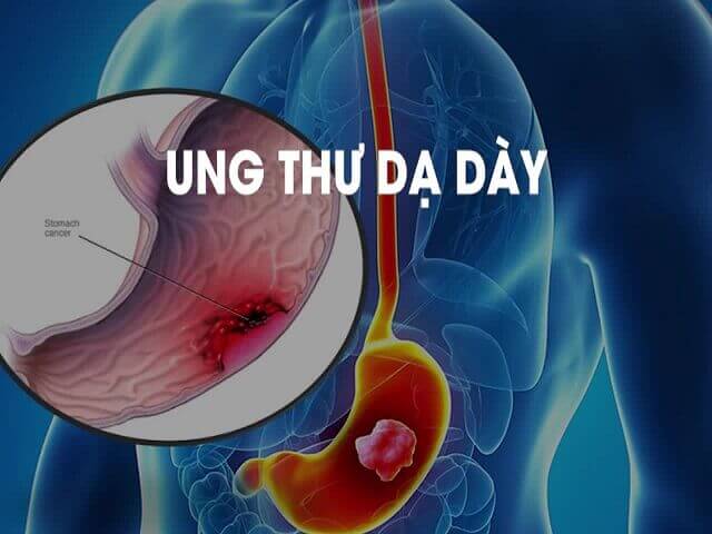 Ung thư dạ dày Ung thư dạ dày