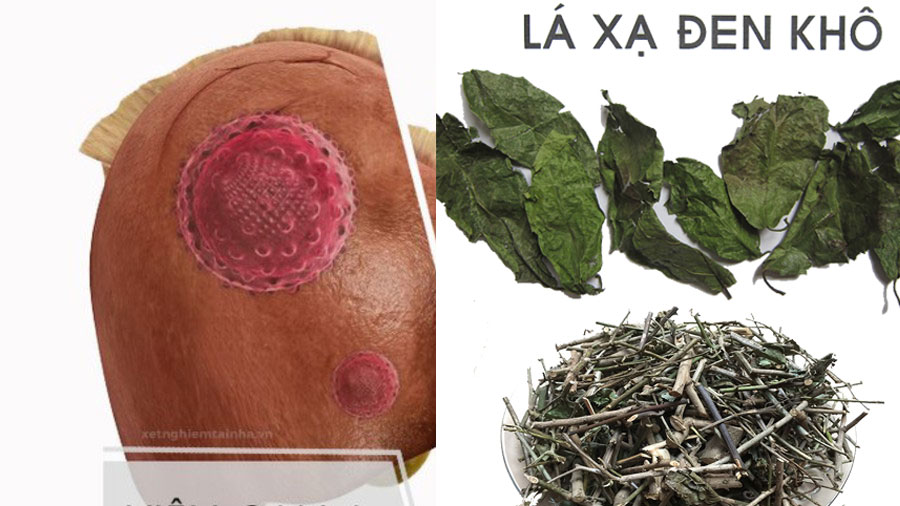Tôi Bị Viêm Gan B Dùng Cao Xạ Đen Hay Thân Lá Cây Xạ Đen ?