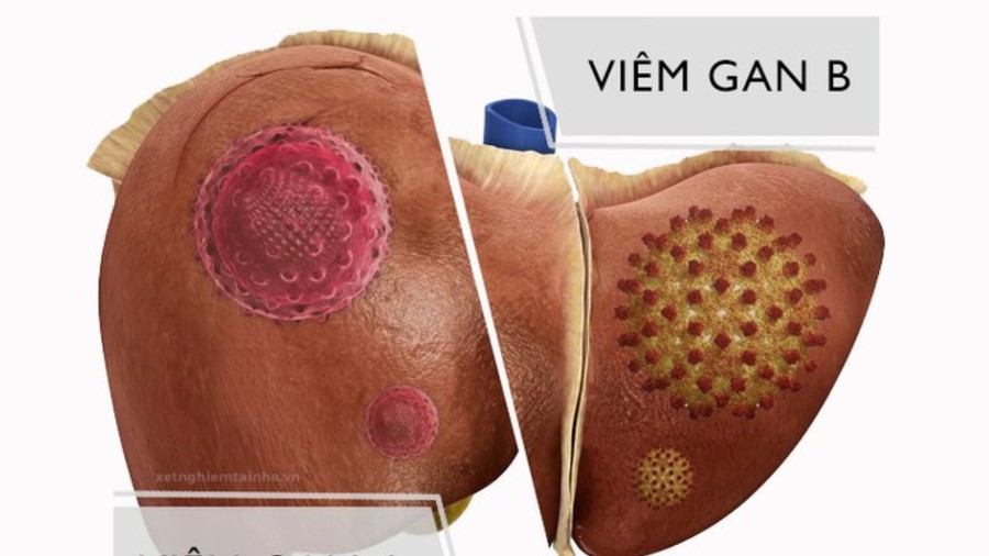 Viêm Gan B