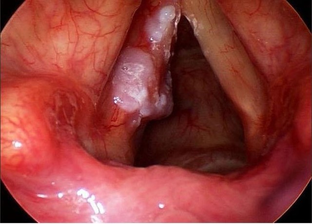Cây xạ đen hỗ trợ điều trị ung thư thanh quản