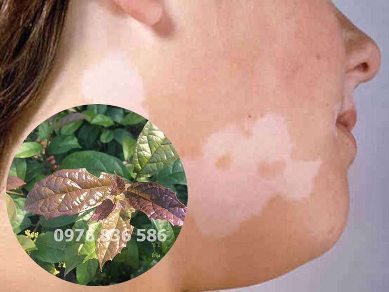 Uống cây xạ đen ảnh hưởng đến sắc tố da không Uống cây xạ đen ảnh hưởng đến sắc tố da không