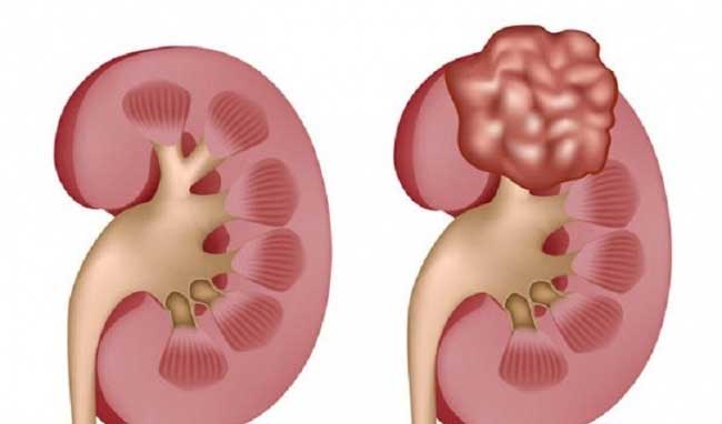 bị nang thận bị nang thận