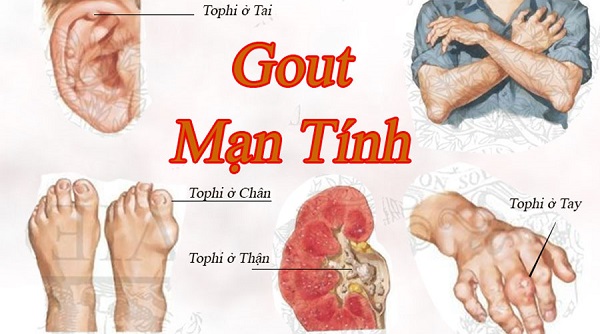 Bệnh Gút Bệnh Gút