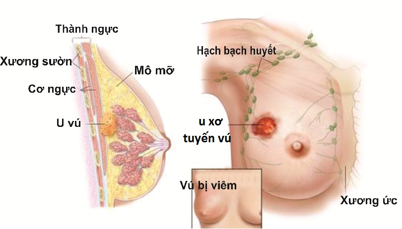Bệnh u xơ tuyến vú Bệnh u xơ tuyến vú