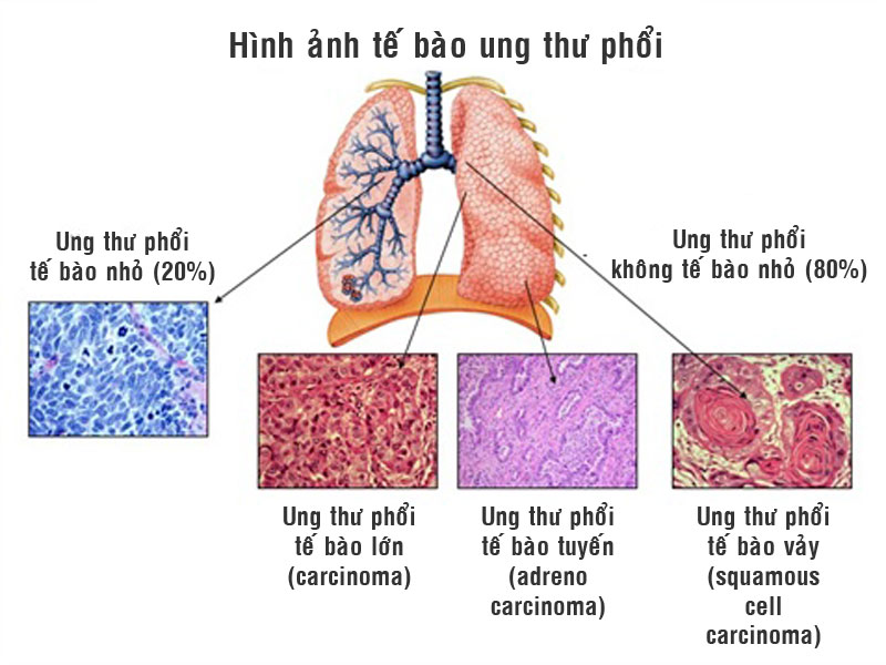Cây xạ đen có tác dụng tốt cho người bị ung thư phổi Cây xạ đen có tác dụng tốt cho người bị ung thư phổi