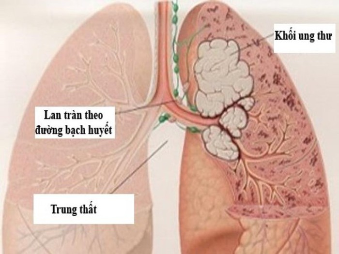 Ung thư trung thất di căn Ung thư trung thất di căn